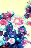 1452356018HIV-infected T cells.jpg